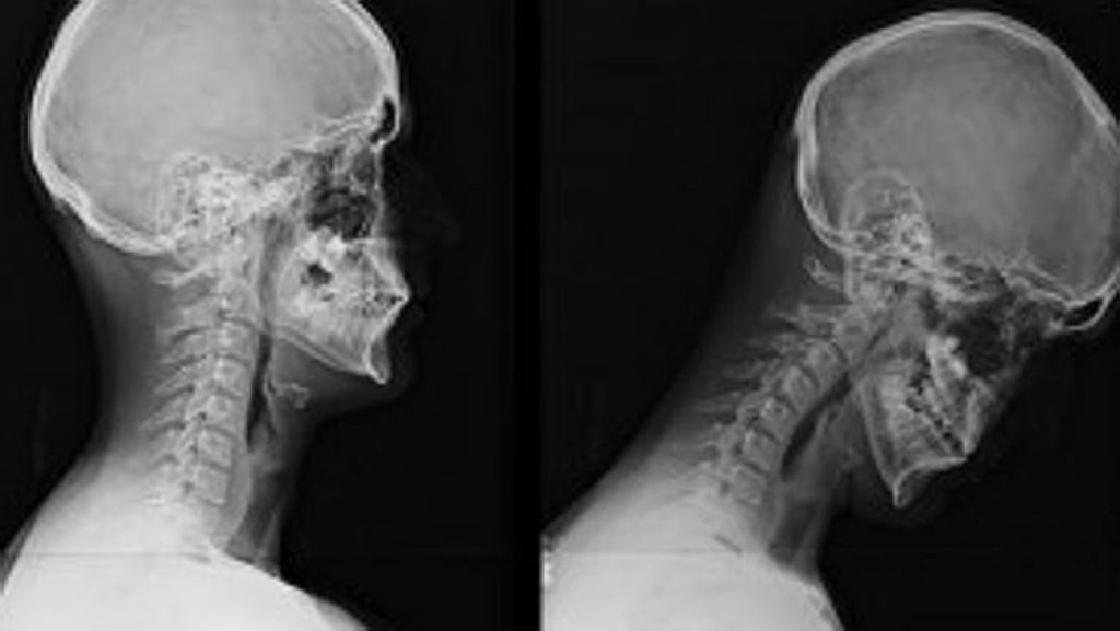 Tech Neck A Modern Day Pain in the Neck