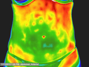 thermography abdominal