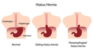 types of hiatal hernia