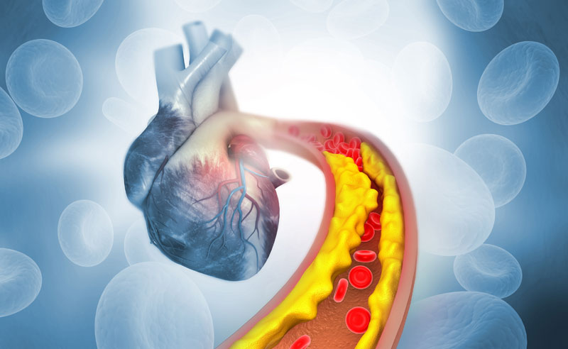 Cholesterol Issues? Don’t Overlook This Common Underlying Cause