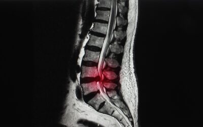 Non-Surgical Spinal Decompression: A Promising Approach for Correcting Spinal Disc Issues